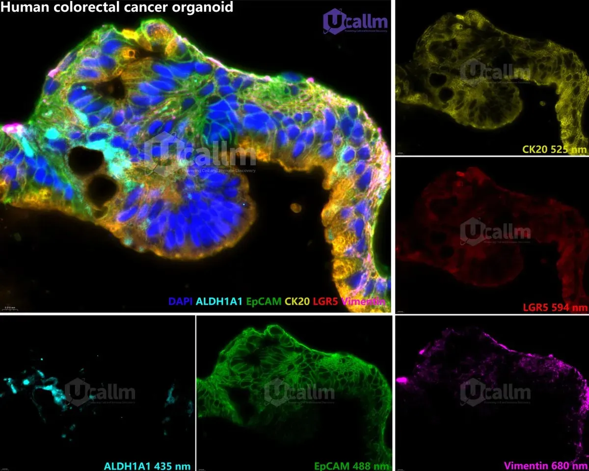 Figure 2. High-magnification 5-Plex 6 color mIHC staining images of human colorectal cancer.webp